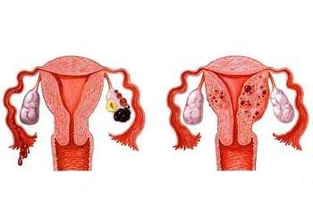 多囊卵巢综合症怎么治疗