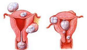 子宫肌瘤诊断方法有哪些?