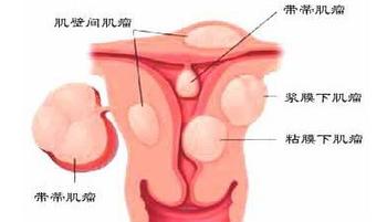 子宫内膜炎的诊断