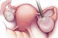 多囊卵巢综合症的临床表现有哪些