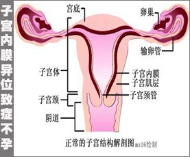 子宫内膜异位的诊断