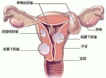 子宫肌瘤的认识误区