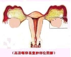 卵巢囊肿种类