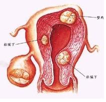 卵巢囊肿