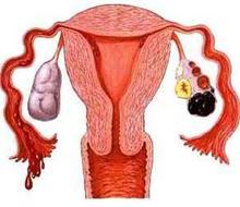 卵巢囊肿有哪些治疗方法