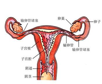 输卵管堵塞的治疗方法有哪些