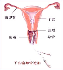 子宫输卵管造影